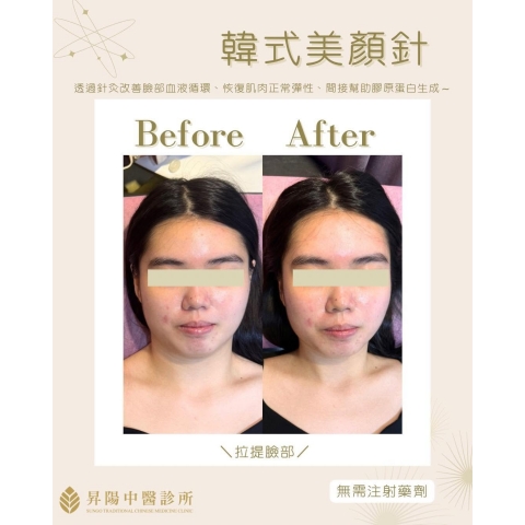韓式美顏針｜自然有感 改善臉部線條