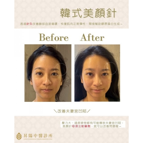自然變美，不靠注射藥劑｜韓式美顏針